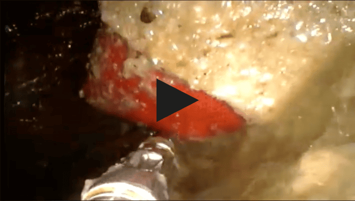Image de lien vers la vidéo de gastroscopie